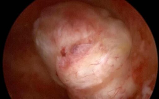 Cos’è il mioma uterino e quando è pericoloso