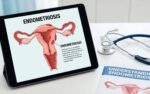 Endometriosi e gravidanza: è possibile con la fecondazione assistita?