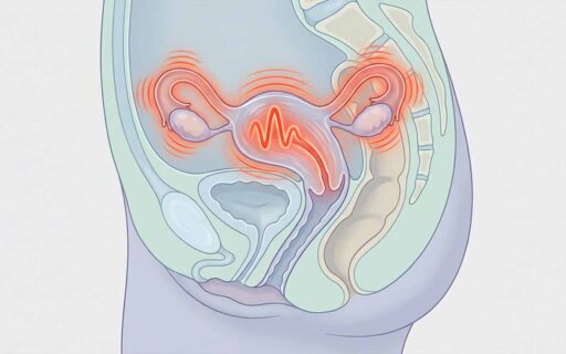 Malattia infiammatoria pelvica: cos’è, come si riconosce, perché non va trascurata