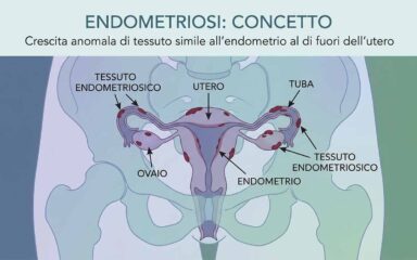 Endometriosi oggi: nuove prospettive, diagnosi precoce e approcci terapeutici in evoluzione